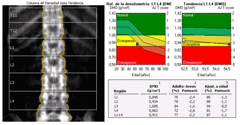 Otros Densitometria Osea Central Cuerpo Completo