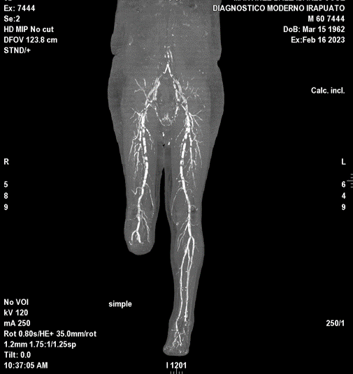 Estudios Radiologícos Angiotomografía Miembros Inferiores