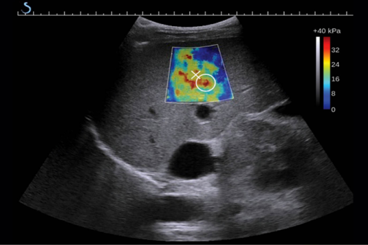 Ultrasonido Elastografía de Higado