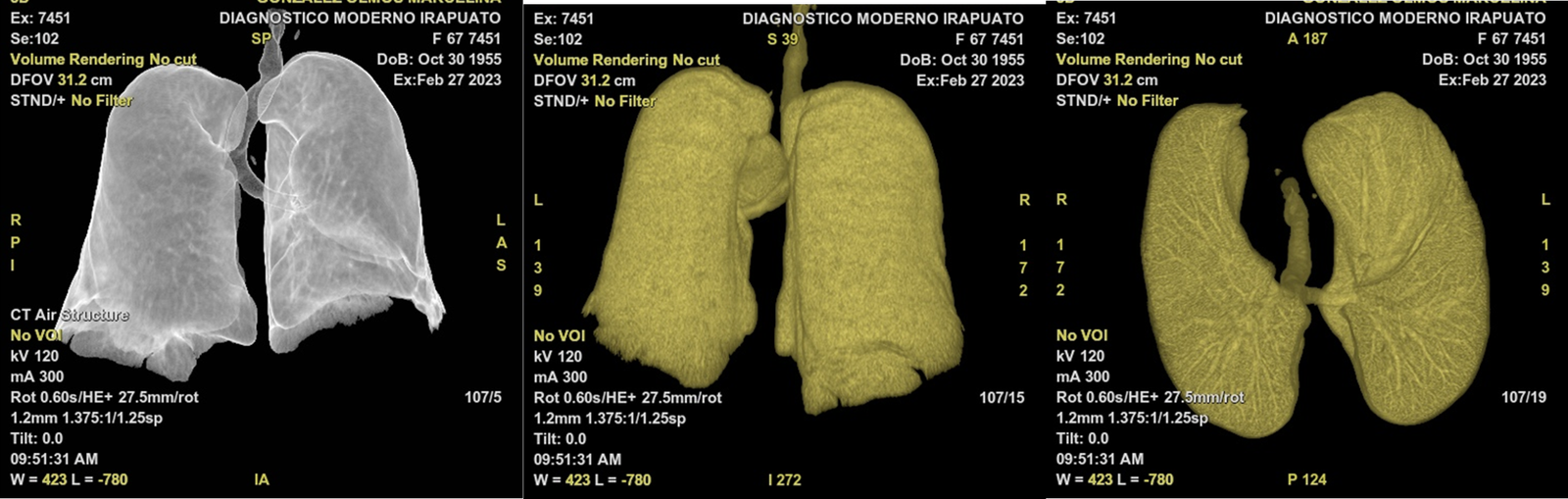 Estudios Radiologícos Tomografía del Torax Alta Resolución