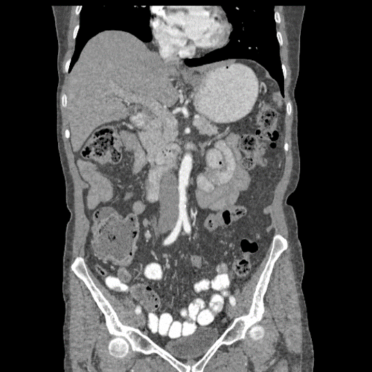 Estudios Radiologícos Tomografía Multicorte de Abdomen