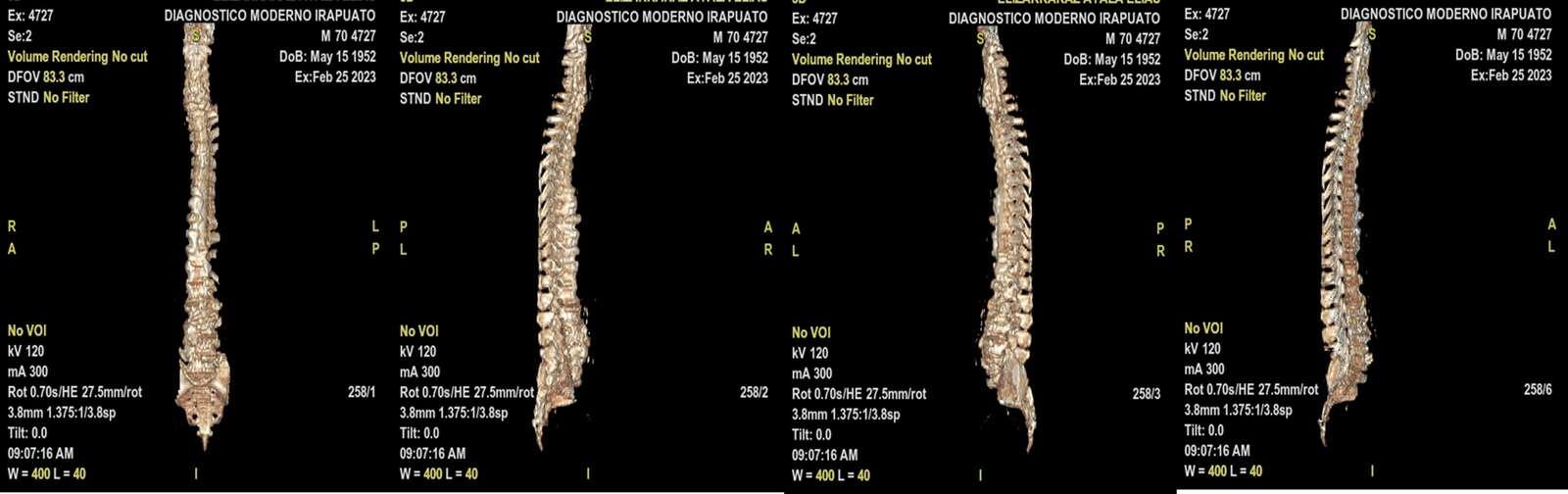 Estudios Radiologícos Tomografía Tridimensional de Columna