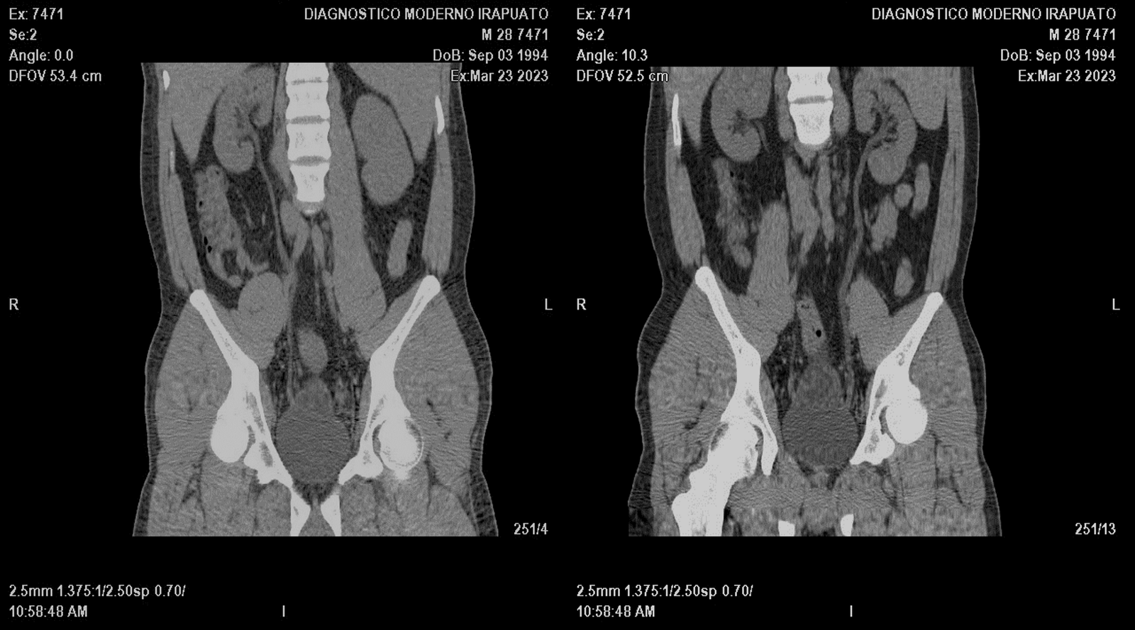 Estudios Radiologícos Urotomografía Simple