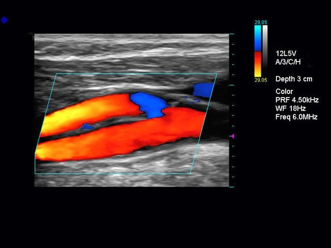 Ultrasonido Carotideo