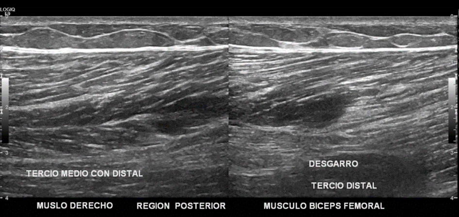 Ultrasonido Musculoesqueletico