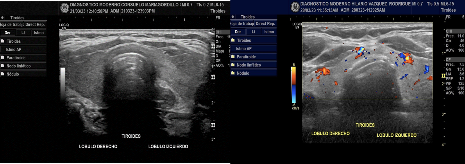 Ultrasonido Tiroides