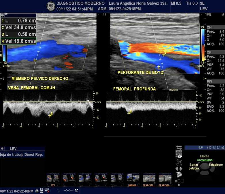 Ultrasonido Vascular